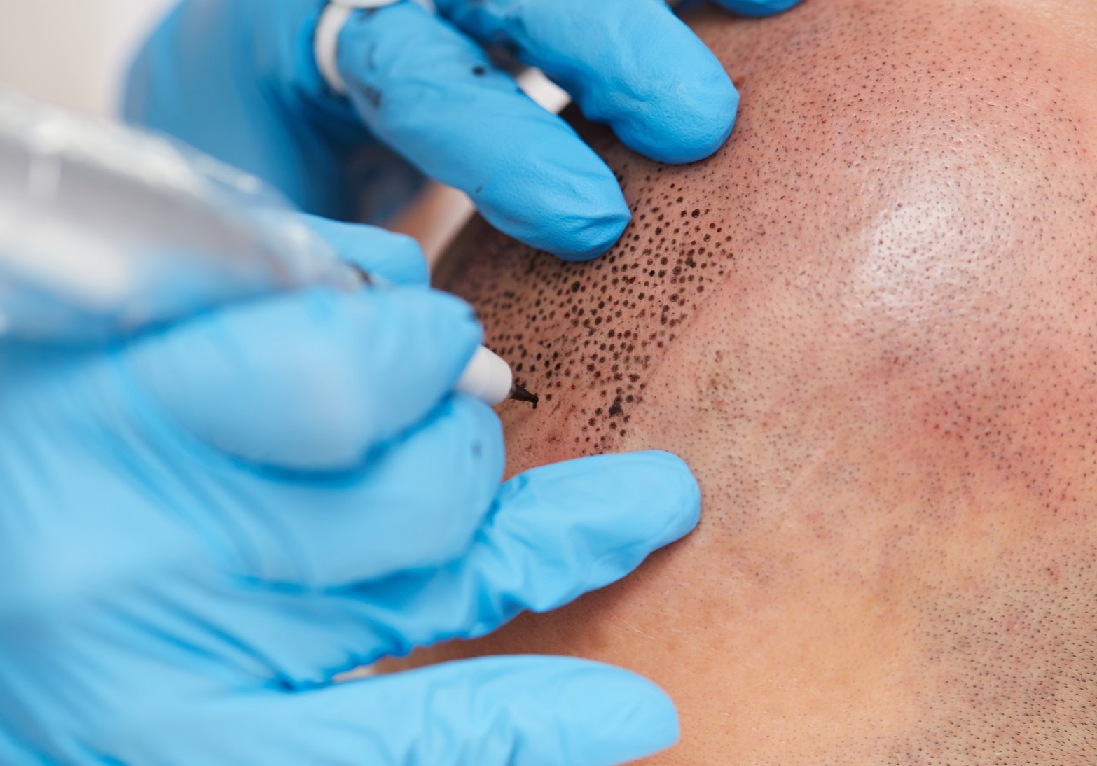 Close-up of scalp micropigmentation showing tiny pigment dots being applied to create the appearance of natural hair follicles
