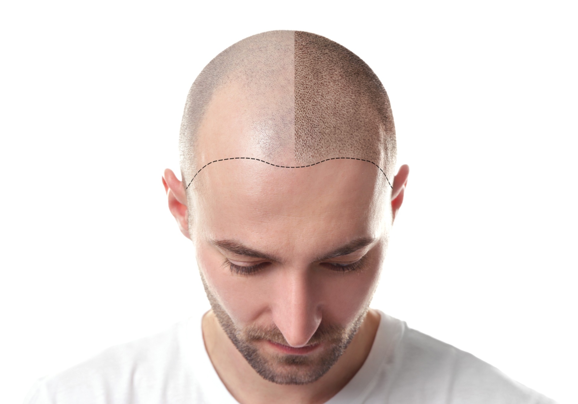 Before and after comparison showing scalp micropigmentation results on a man's head