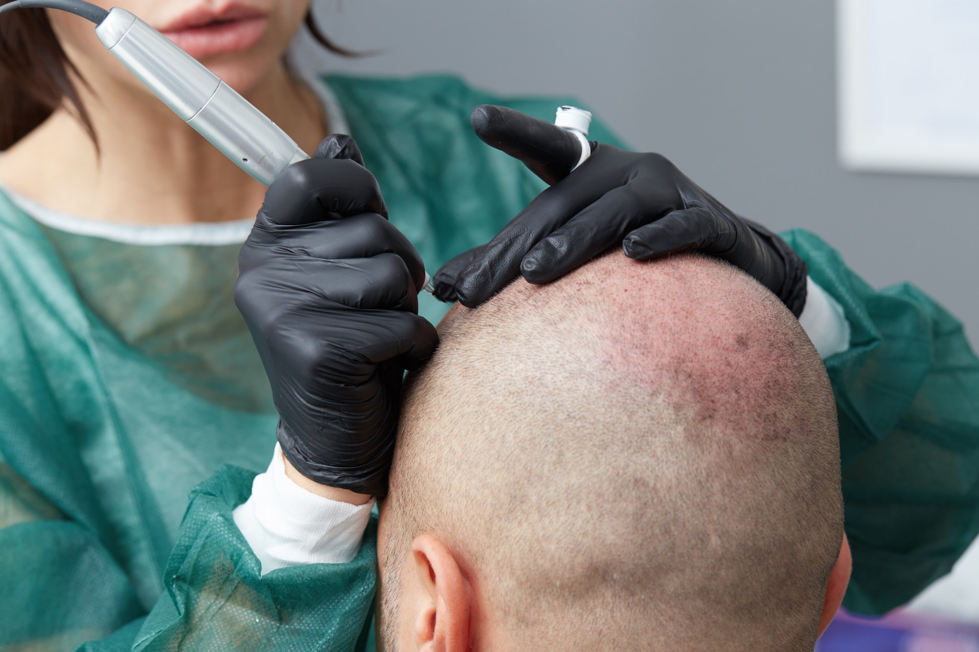 Scalp micropigmentation treatment being applied with precision equipment